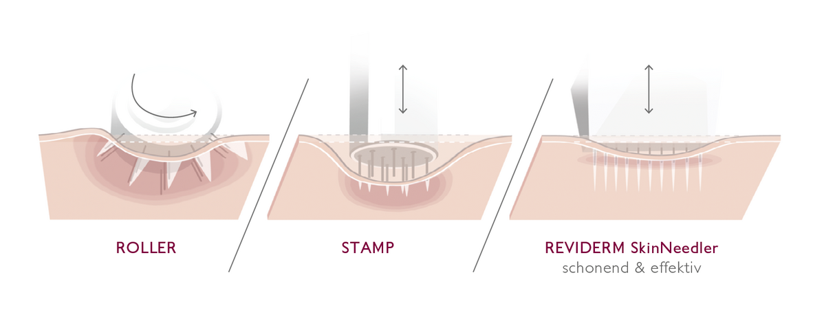 Reviderm Micro-Needling